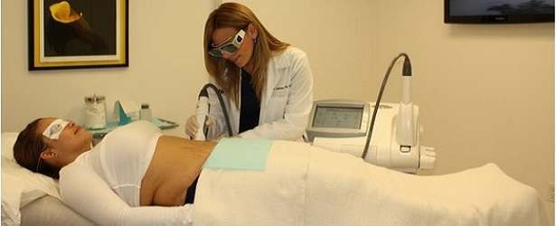 Laser Treatment for Stretch Marks
