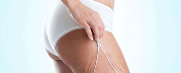 Methods for Hiding Stretch Marks