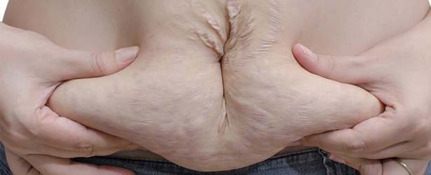 Painful Stretch Marks